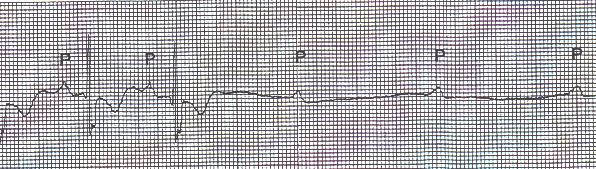 Asystole/Ventricular Standstill