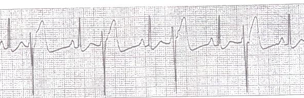 Bigeminy PVCs (every other beat is a PVC)